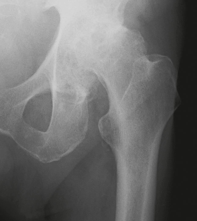 Röntgenbild einer erkrankten Hüfte