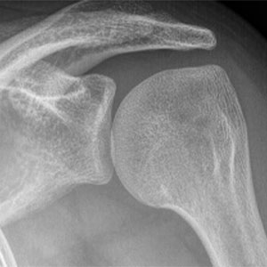 Röntgenaufnahmen einer gesunden Schulter