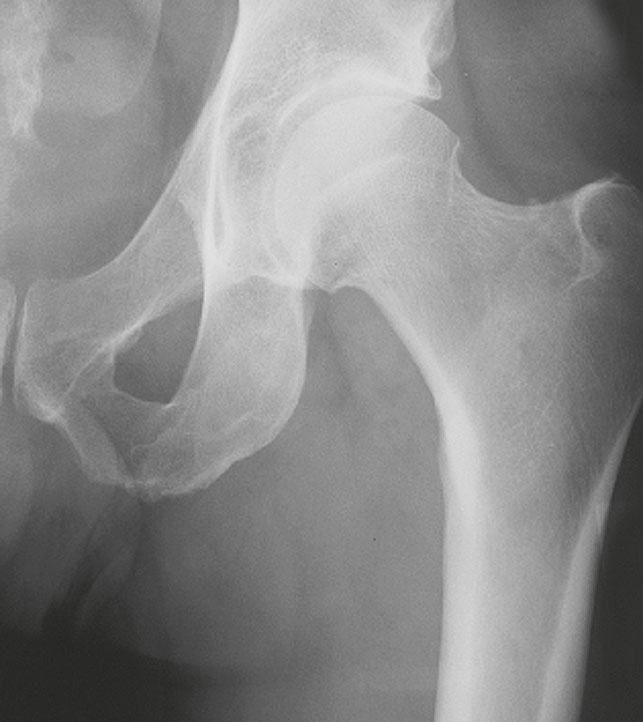 Röntgenbild einer gesunden Hüfte