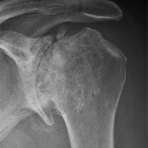 Röntgenaufnahmen einer erkrankten Schulter
